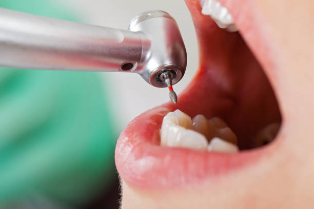 Best Emergency Dental Extractions in Chino Hills, CA